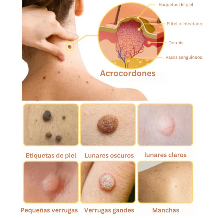 🐝Nuevo Combo 2X1 Tratamiento Spray Eliminador De Verrugas + Crema Aclarante Para Piel