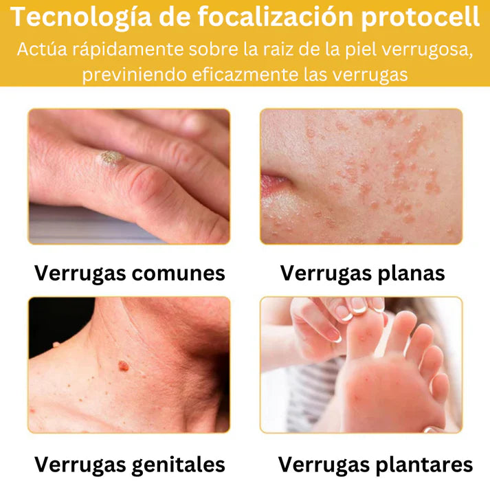 🐝Nuevo Combo 2X1 Tratamiento Spray Eliminador De Verrugas + Crema Aclarante Para Piel