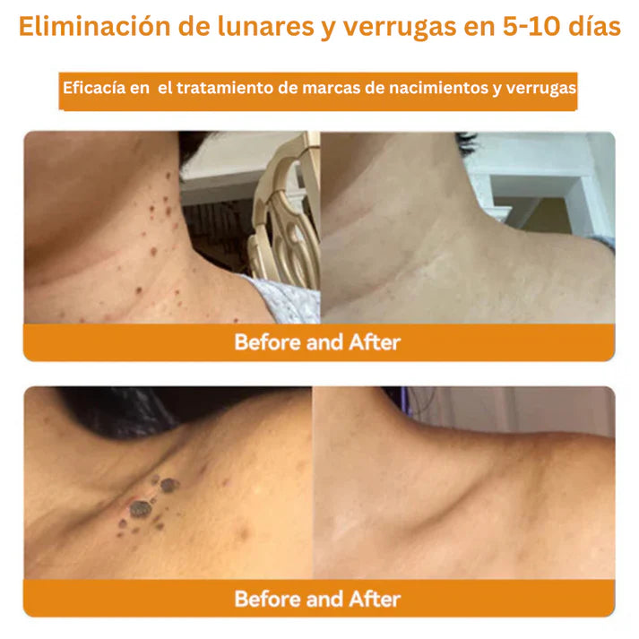 🐝Nuevo Combo 2X1 Tratamiento Spray Eliminador De Verrugas + Crema Aclarante Para Piel