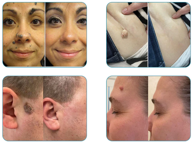 ¡Lápiz Laser Grado Medico PielZen!💎